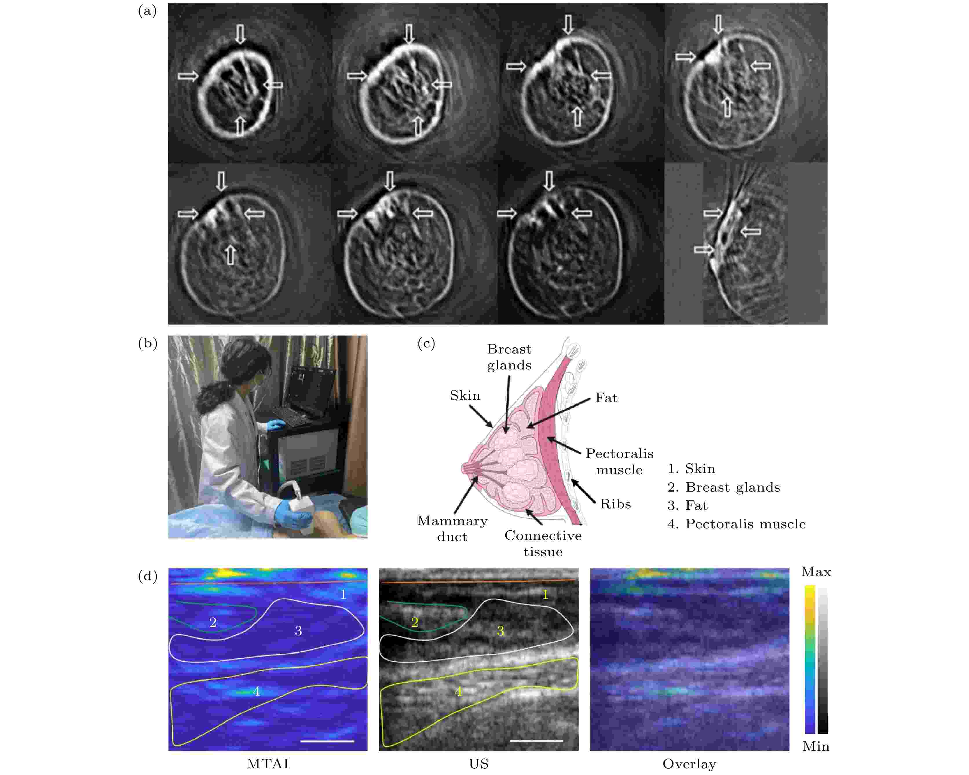 Biomedical microwave-induced thermoacoustic imaging